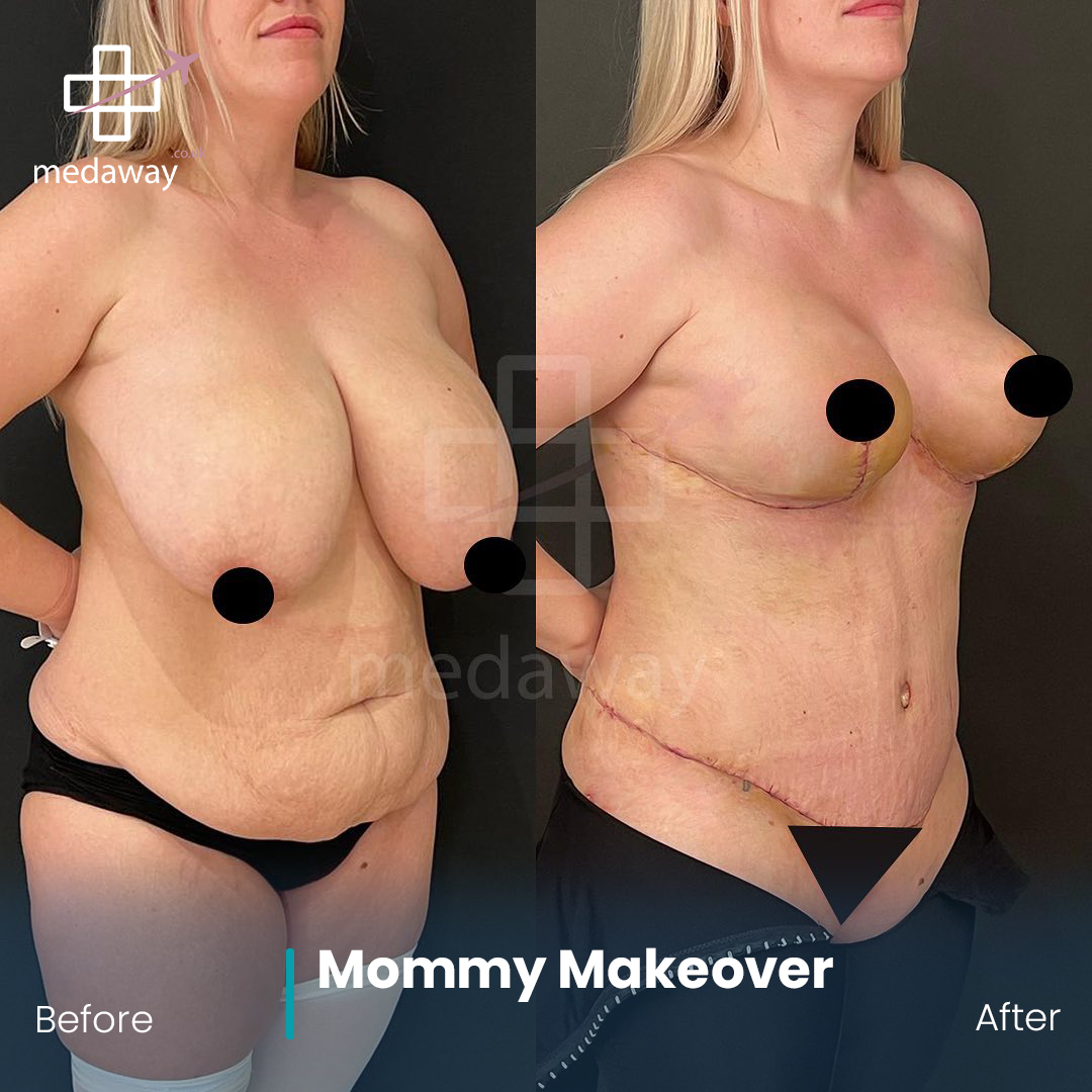 Mommy Makeover