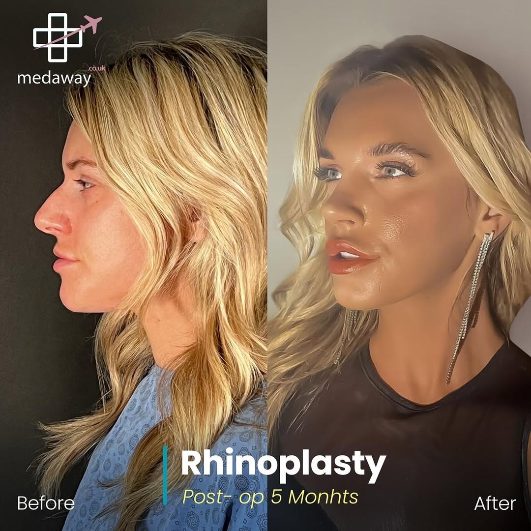 rhinoplasy before&after