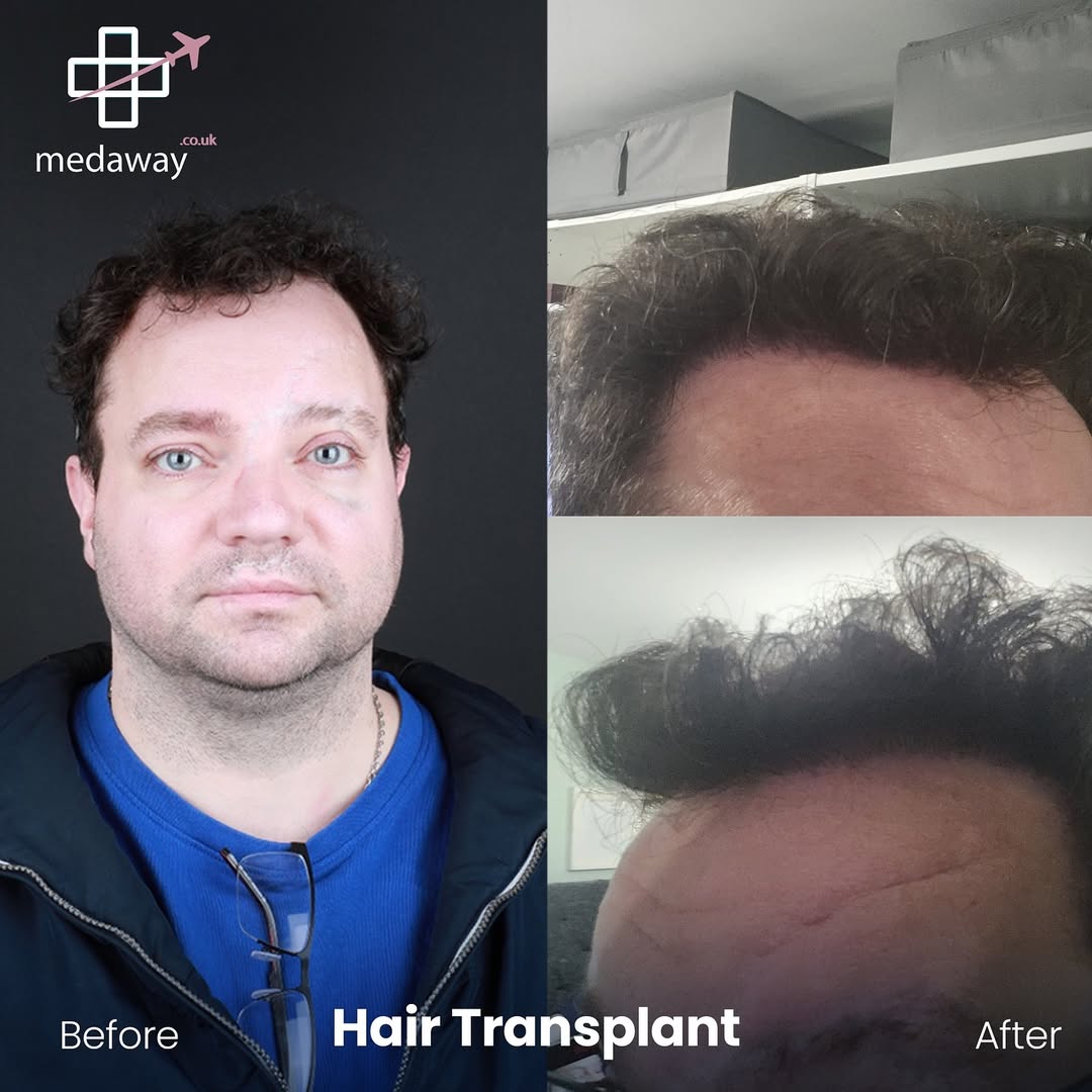 hair transplant before and after