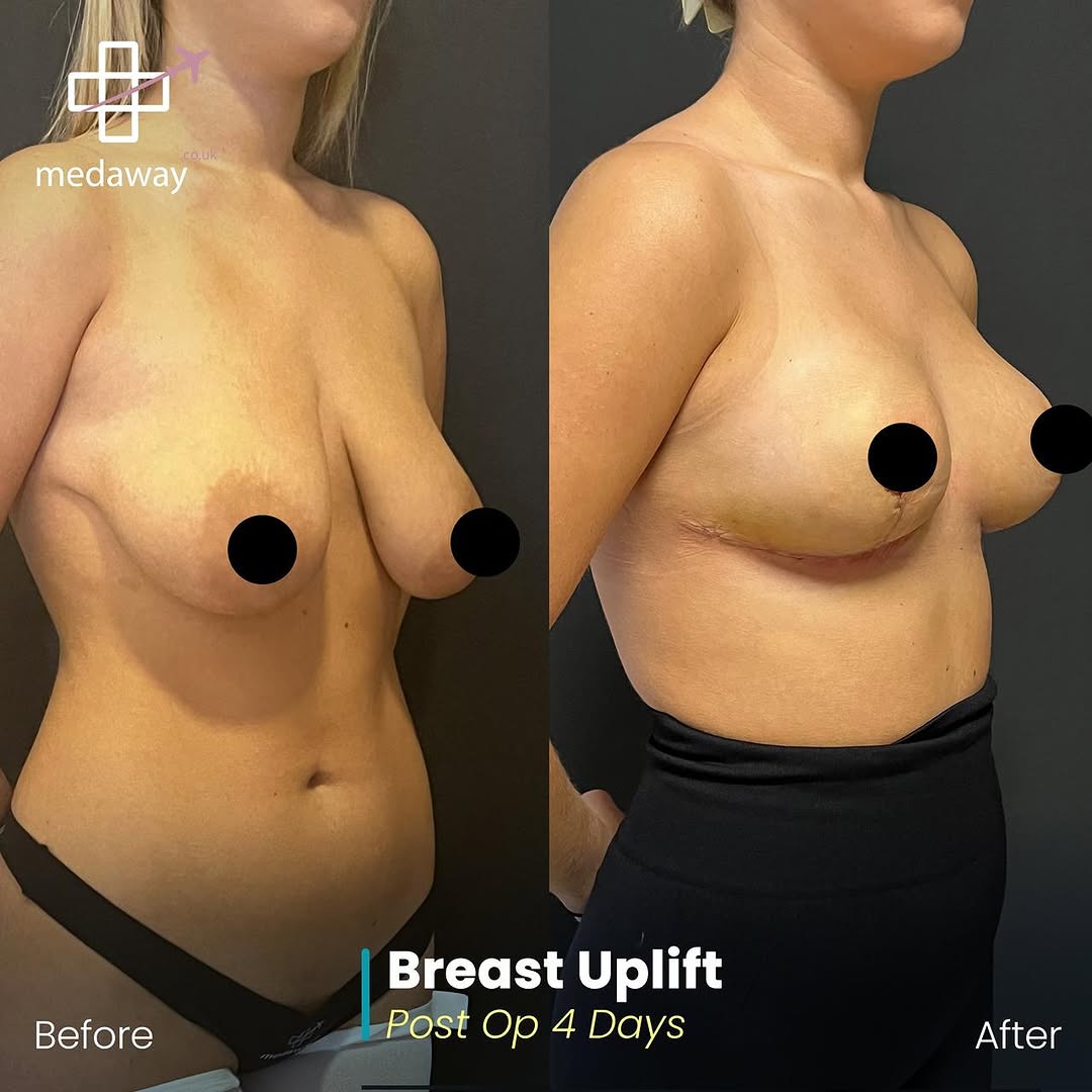 Boob Job
