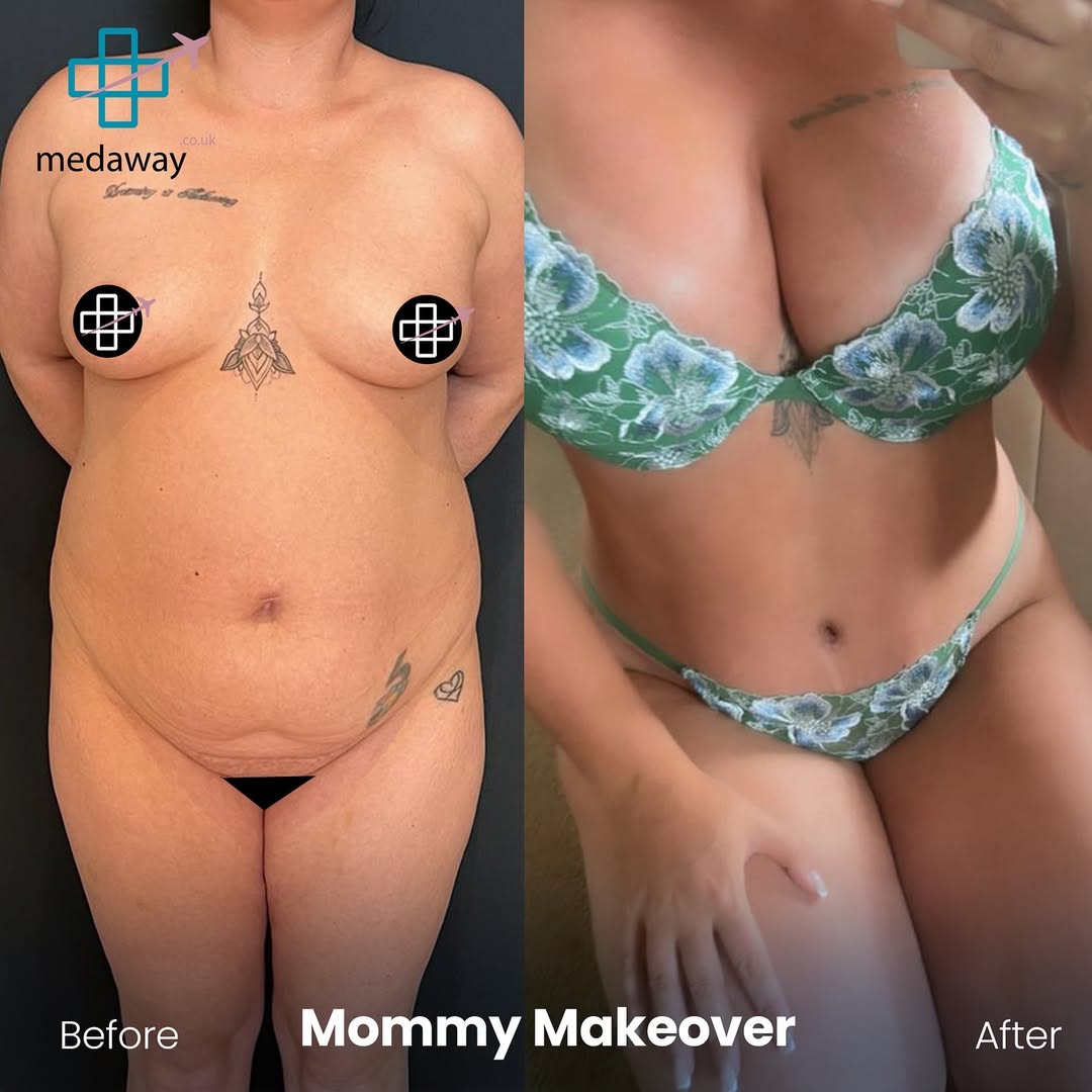 Mommy Makeover