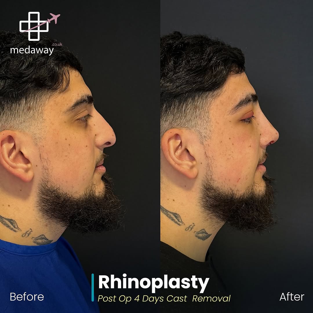 rhinoplasy before&after