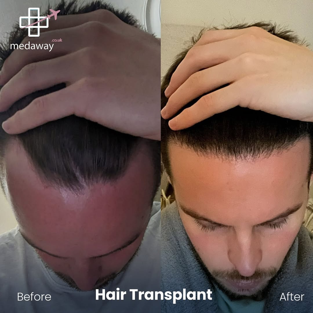 hair transplant before and after