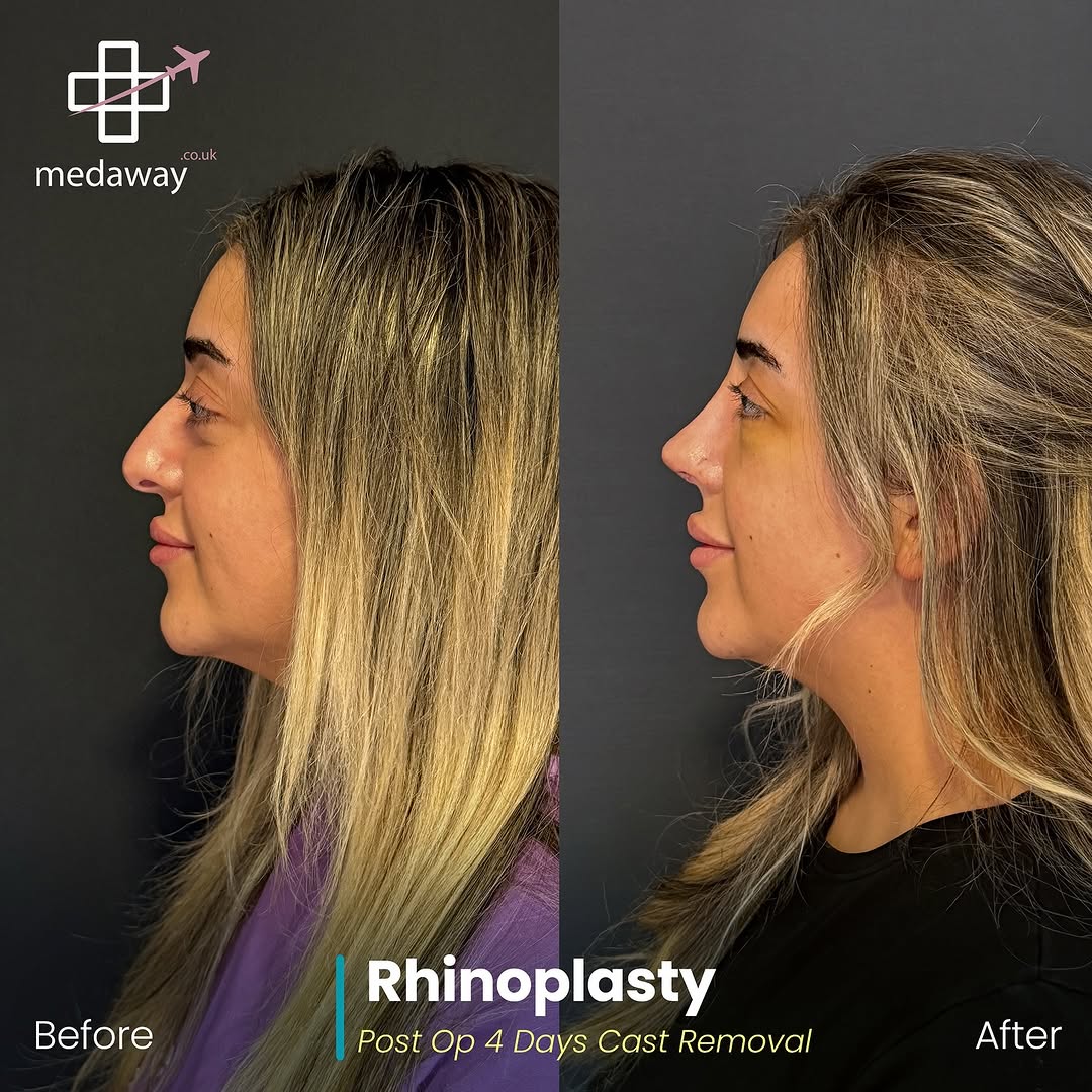 rhinoplasy before&after