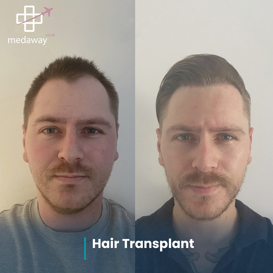 hair transplant before and after