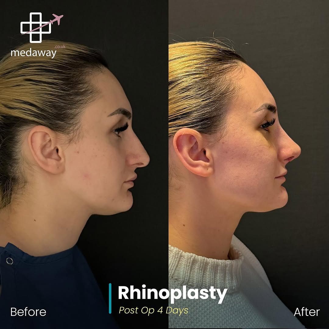 rhinoplasy before&after